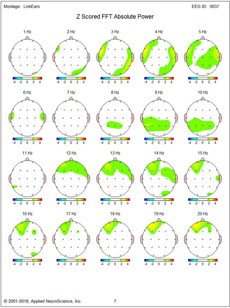Figure 16 - Post-neurofeedback eyes-closed z-score FFT absolute power single-Hz bins 1-20 Hz